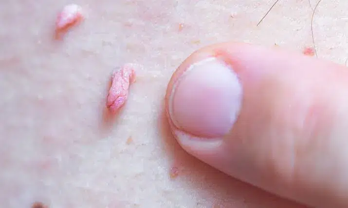 زگیل تناسلی